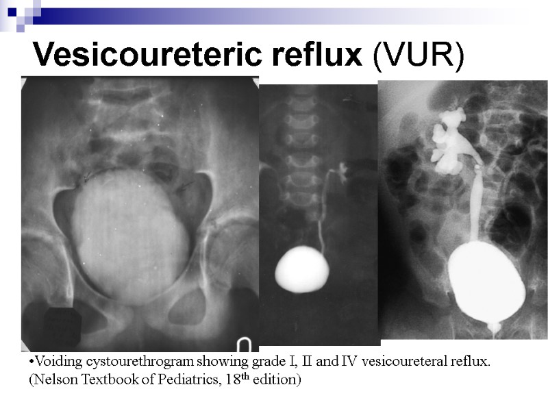 Vesicoureteric reflux (VUR)  Voiding cystourethrogram showing grade I, II and IV vesicoureteral reflux.